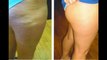 Truth About Cellulite - FREE Cellulite Removal Presentation