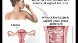 Natural Cure for Yeast Infection