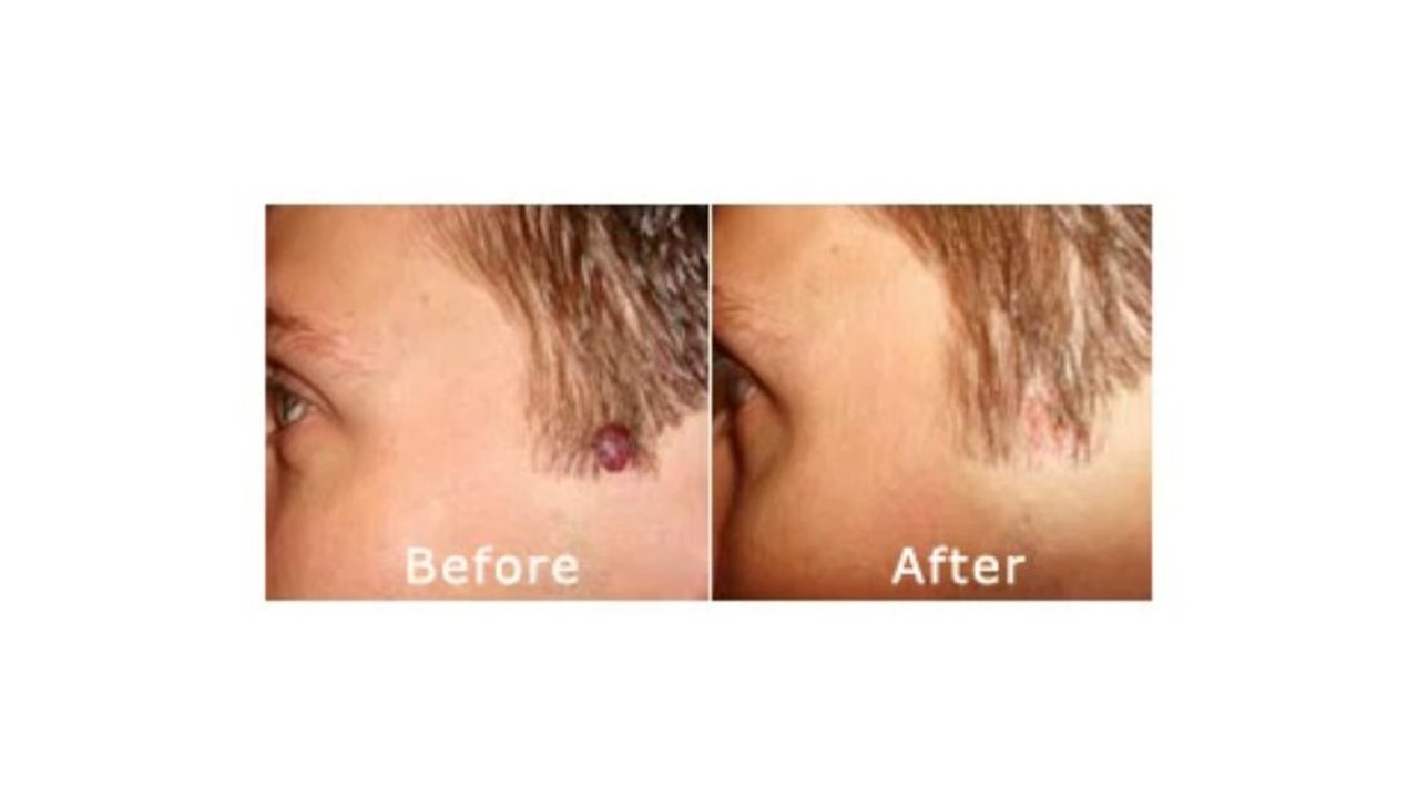 Moles, Warts & Skin Tags Removal