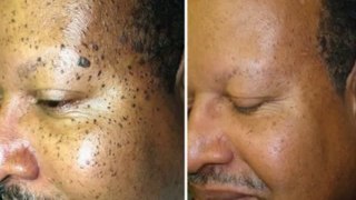 Moles warts skin tags removal australia Natural Cure