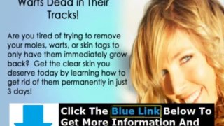 Moles Warts & Skin Tags Removal Ebook Review + Does Moles Warts Removal Work