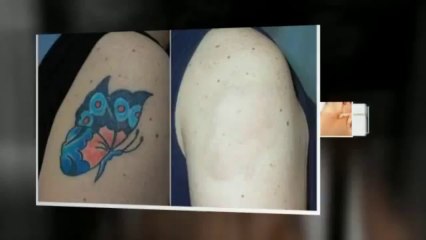 get rid tattoo naturally ebook - treatment to remove tattoos