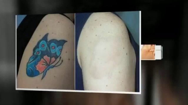 get rid tattoo naturally ebook - treatment to remove tattoos