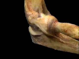 Acland&#39;s Video Atlas of Human Anatomy: Elbow