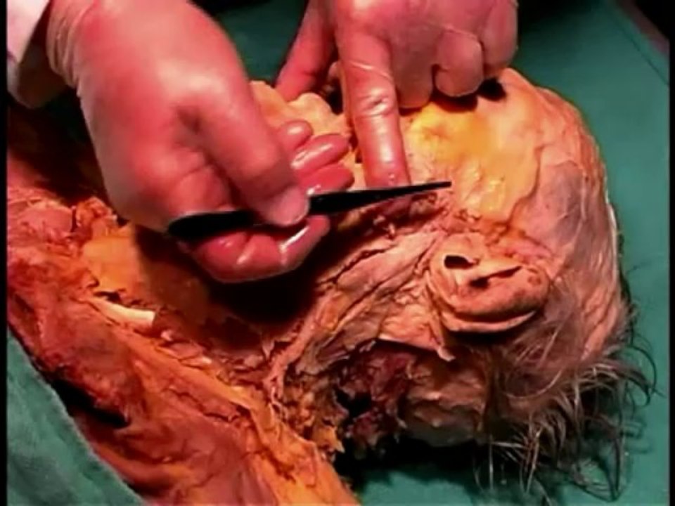 Human Anatomy Dissection 11 Superficial Face