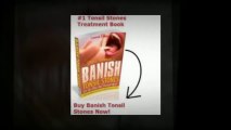 Banish Tonsil Stones - How To Remove Tonsil Stones