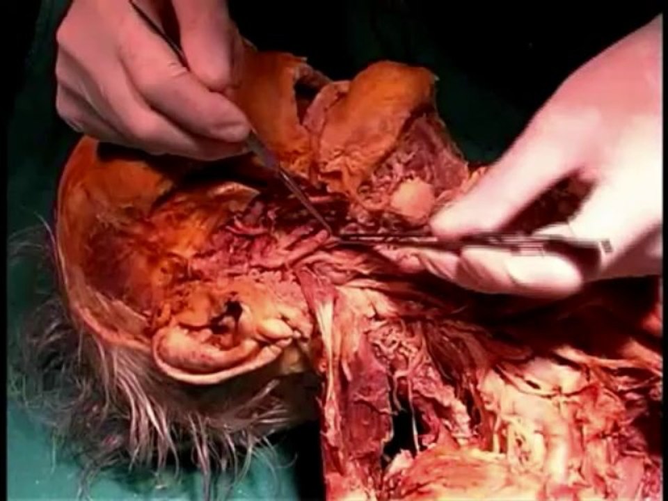 Human Anatomy Dissection 14 (part 1 of 2) Deep Neck