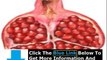 Homeopathic Kidney Stone Remedy + Kidney Stone Relief Home Remedy