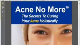 Acne No More Review  Scam or Legit