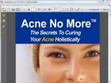 Acne No More Review  Scam or Legit