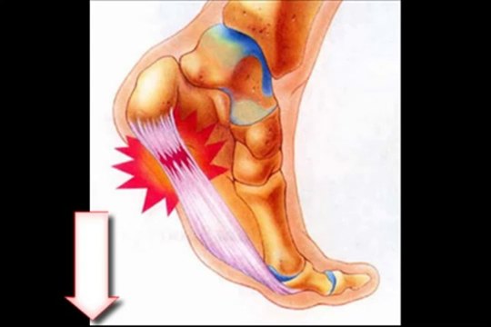 Cure Plantar Fasciitis | Plantar Fasciitis Secrets Revealed