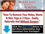 Moles Warts Removal Review   Moles Warts & Skin Tags Removal Pdf