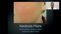 Banish my bumps find out how I use Banish my bumps to eliminate Keratosis Pilaris