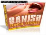 Banish Tonsil Stones Review - Banish Tonsil Stones PDF