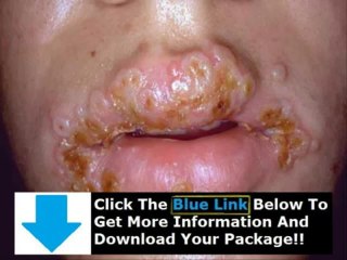 How You Get Rid Of Herpes + How To Get Rid Of Herpes Pain