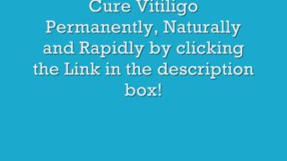 Vitiligo Treatment - Natural Vitiligo Treatment System Review
