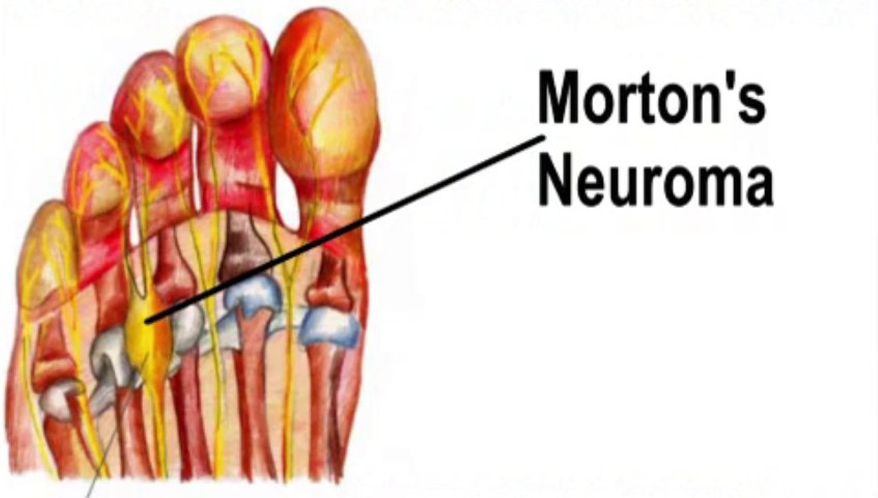 Podiatrist - Morton’s Neuroma  - Palm Harbor and Tarpon Springs, FL