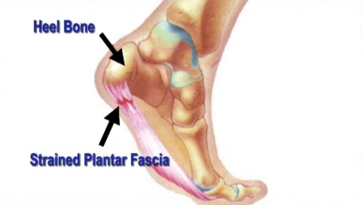 Heel Pain - Pinellas County and Oldsmar, FL - Podiatrist