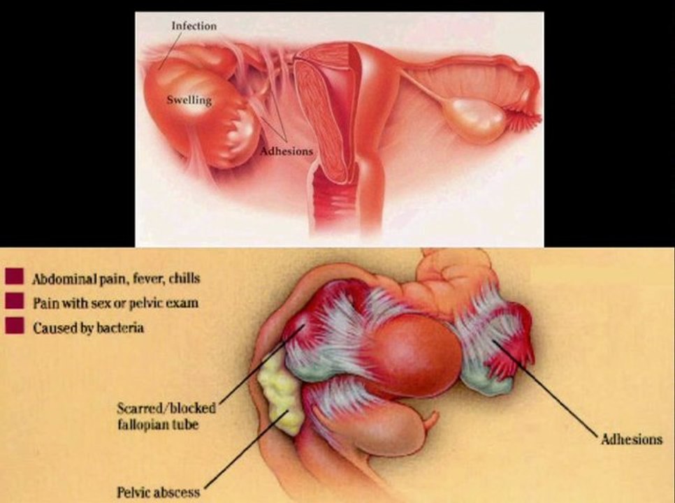 Sintomi e Cura Cervicite