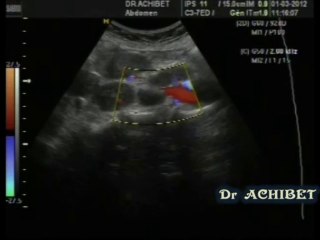 adenopathies  cancer estomac