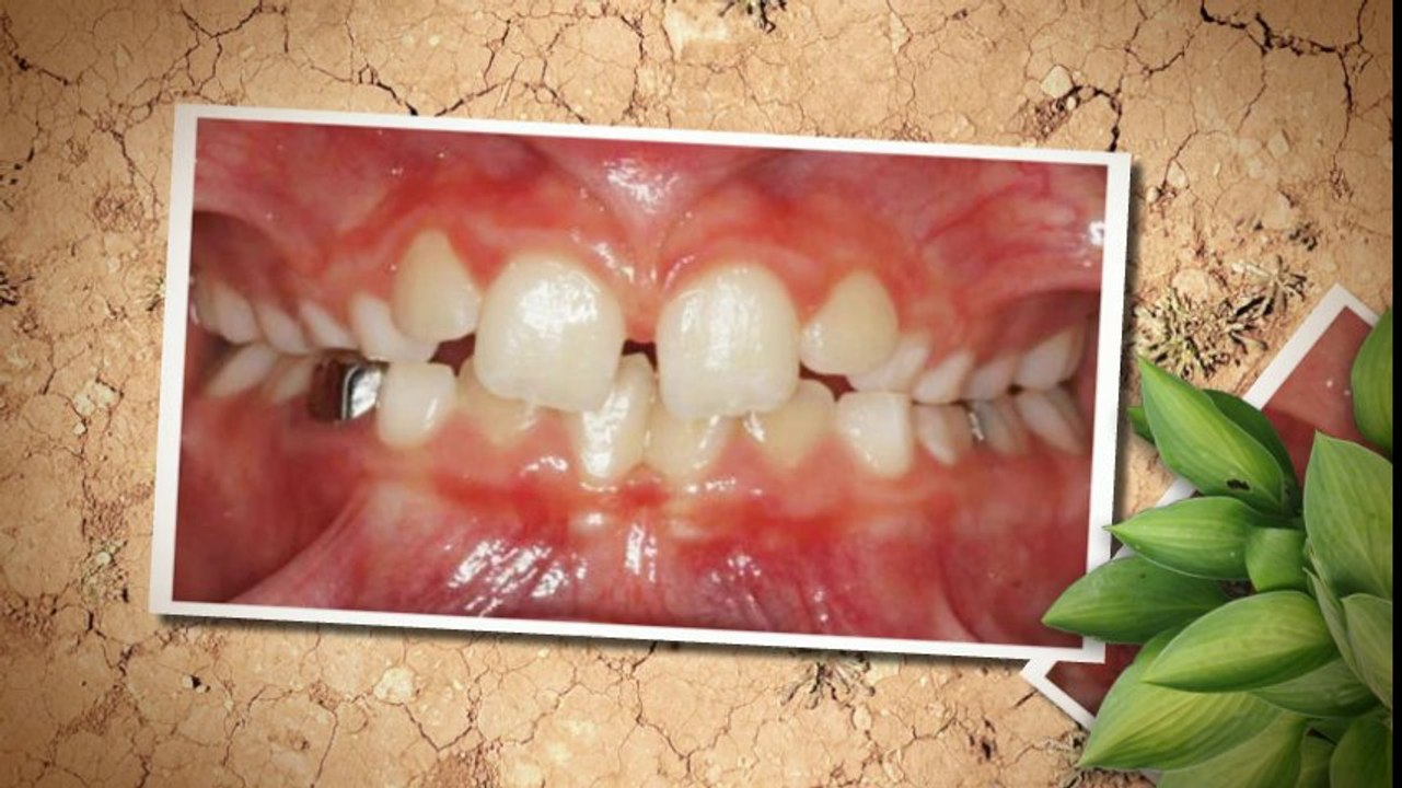 Colorado Springs Braces July2013