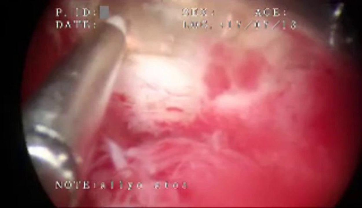 Histeroskopik Polip Operasyonu