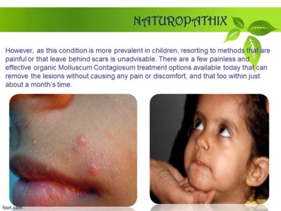 Painless Molluscum Contagiosum Treatment