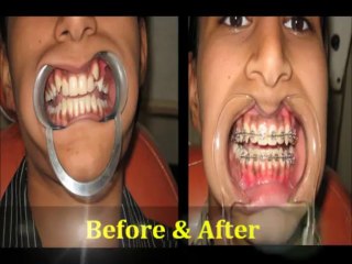 striaght teeth with braces
