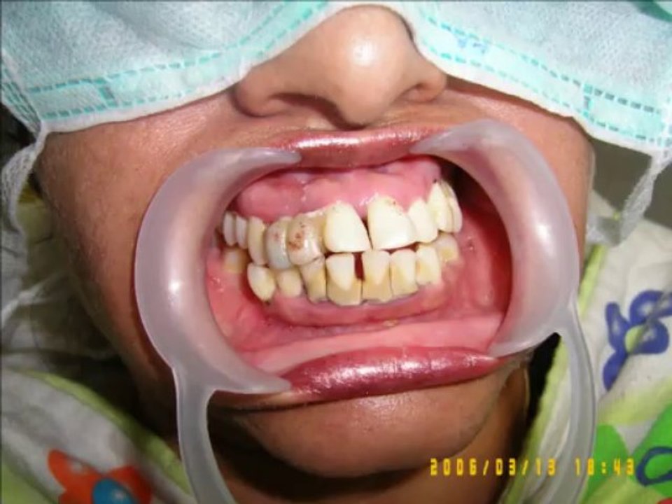 Full mouth Bridge case