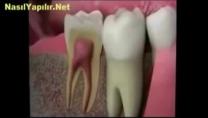 Kanal Tedavisi Nasıl Yapılır_ _ NasılYapılır.Net _