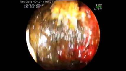 Kayıhan Günay - Bouveret sendromu