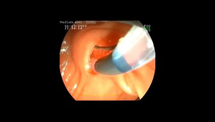 Dr Kayıhan Günay ERCP sfinkteretomi