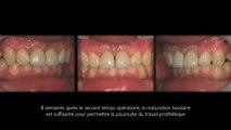 Implants dentaires/Dental Implants: Incisives centrales/Central Incisors