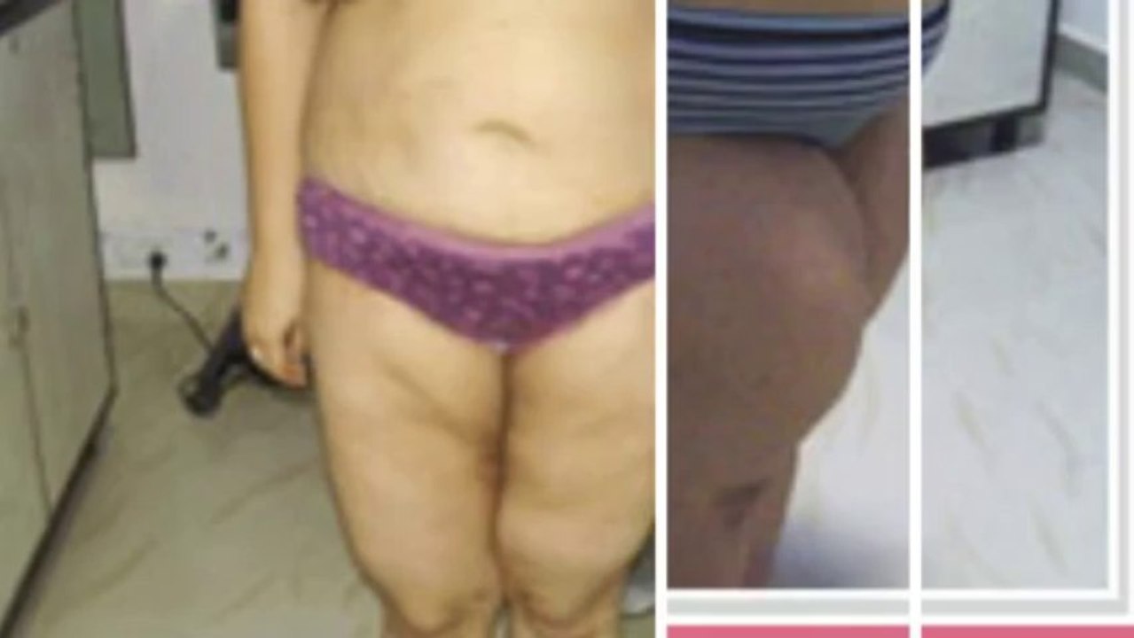 Get Best Solutions for Breast Surgery in Delhi NCR, Weight Loss Surgeries