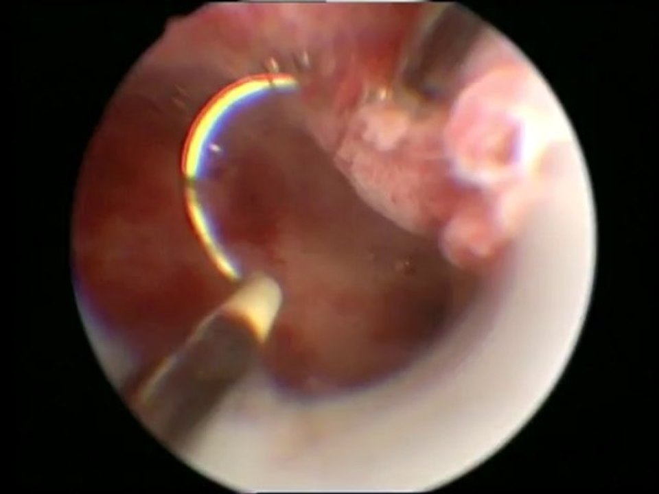 Histeroskopik Polip Rezeksiyonu Operasyonu