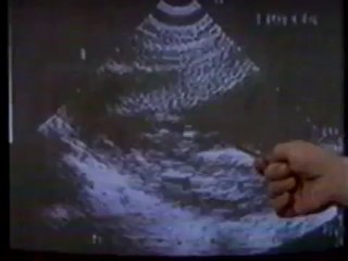 ABORTO - GRITO SILENCIOSO - DOCUMENTÁRIO