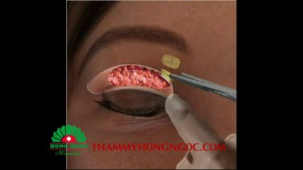 Cắt mắt 2 mí hàn quốc | Cat mat hai mi han quoc