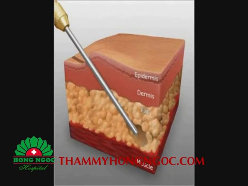 Video Hút mỡ bụng | Hut mo bung