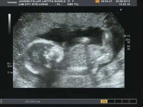 Echographie 19sa - bb4