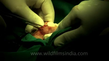 Surgery of Fibroid in Breast-hdv-fx-1-01-1
