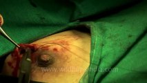 Surgery of Fibroid in Breast-hdv-fx-1-01-21