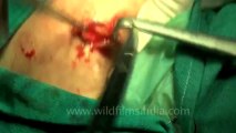 Surgery of Fibroid in Breast-hdv-fx-1-01-29