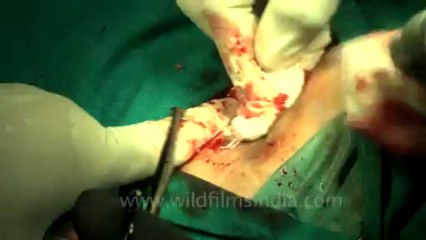 Surgery of Fibroid in Breast-hdv-fx-1-01-30