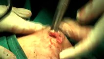 Surgery of Fibroid in Breast-hdv-fx-1-01-36