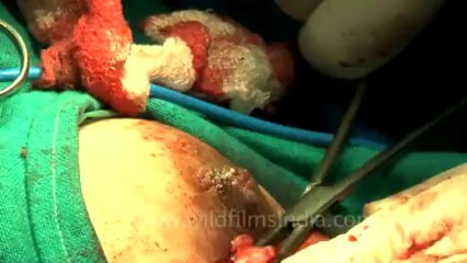 Surgery of Fibroid in Breast-hdv-fx-1-01-41