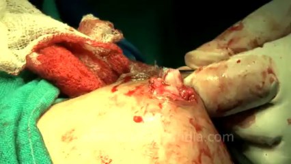 Surgery of Fibroid in Breast-hdv-fx-1-01-43