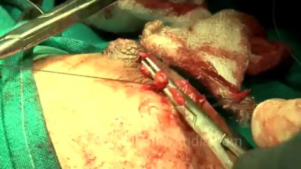 Surgery of Fibroid in Breast-hdv-fx-1-01-47