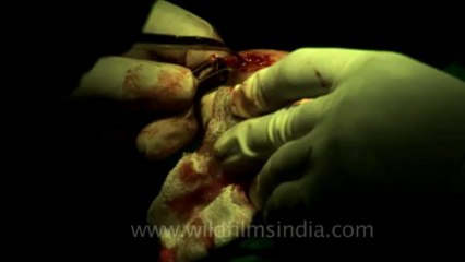 Surgery of Fibroid in Breast-hdv-fx-1-01-5