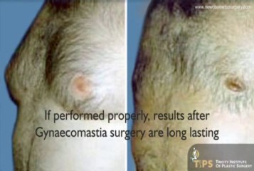 Male Breast Reduction in India