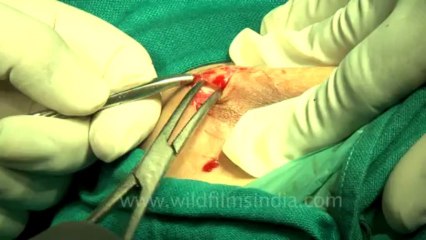 Surgery of Fibroid in Breast-hdv-fx-1-01-26